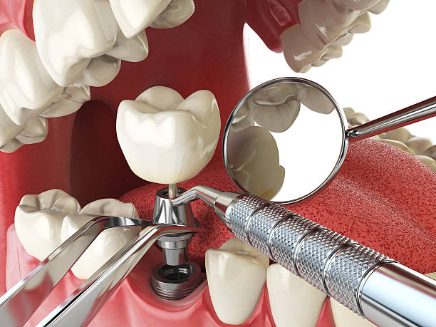 Best Emergency Dental Care for Broken or Chipped Teeth in Dollar Bay, MI